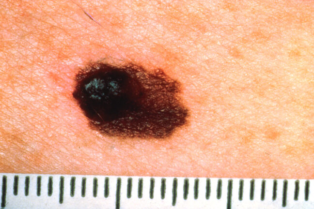 Foto de melanoma assimétrico, com metades diferentes