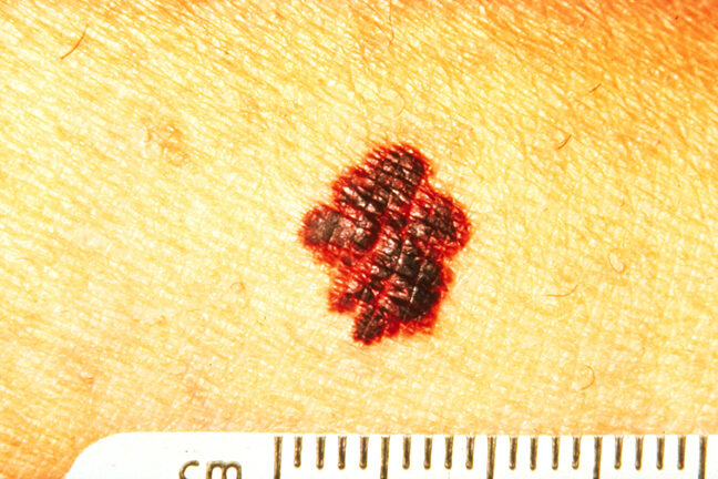 Foto de melanoma com bordas irregulares e mal definidas