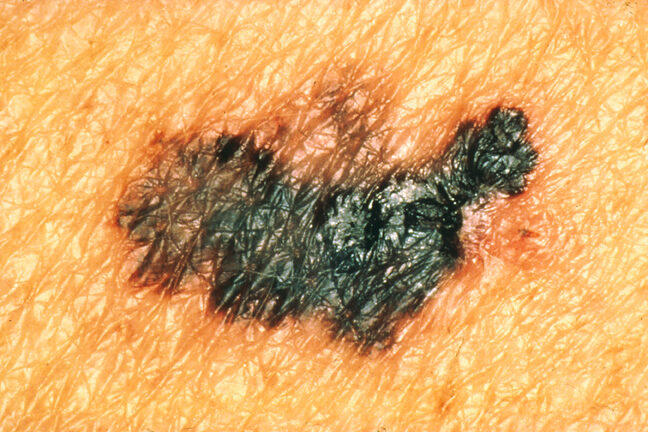 Foto de melanoma com várias cores na mesma lesão