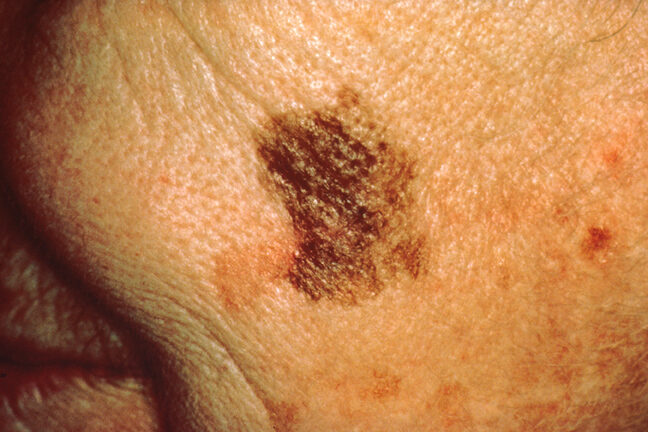 Foto de melanoma com diâmetro grande, maior que 6 mm