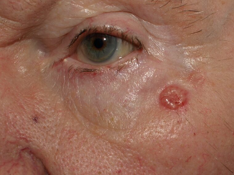 Exemplo de carcinoma basocelular nodular na pele