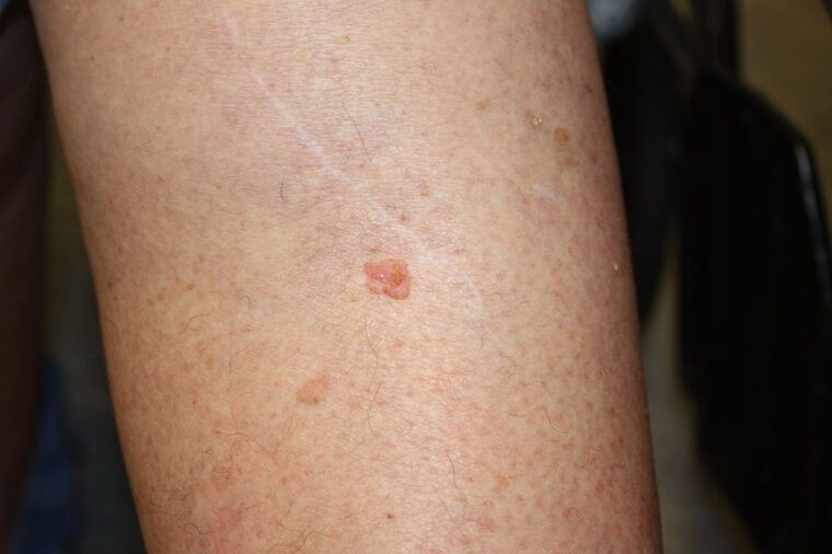 Carcinoma espinocelular, lesão escamosa