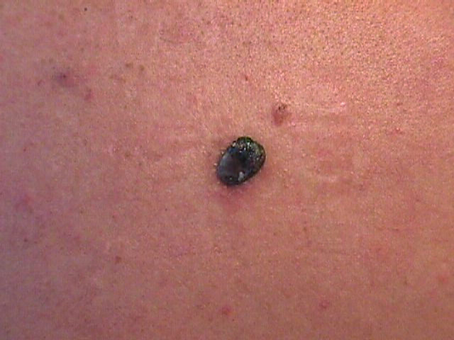 Melanoma nodular