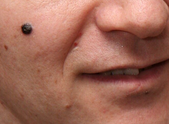 Melanoma: pinta escura e assimétrica